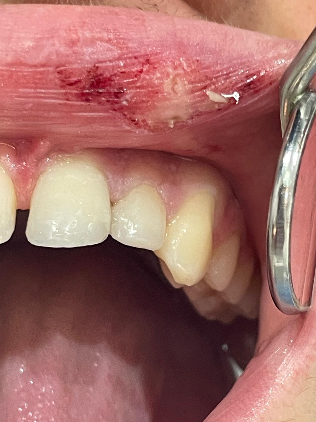 Odontología Conservadora Gavà | Empastes y Obturaciones